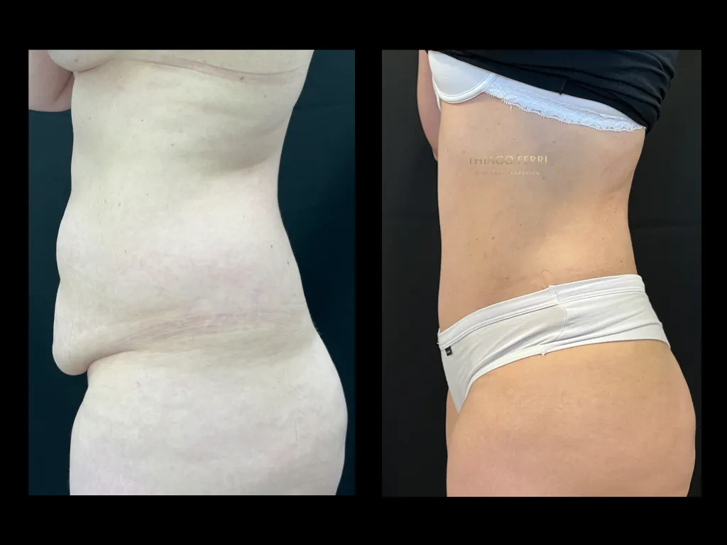 Antes e depois abdominoplastia em Chapecó