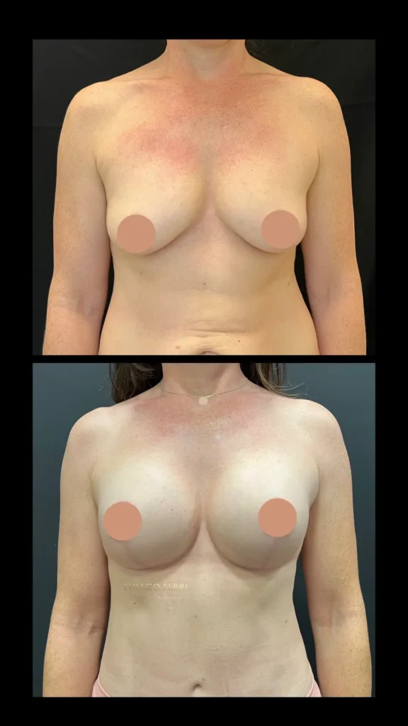 Antes e depois de mastopexia