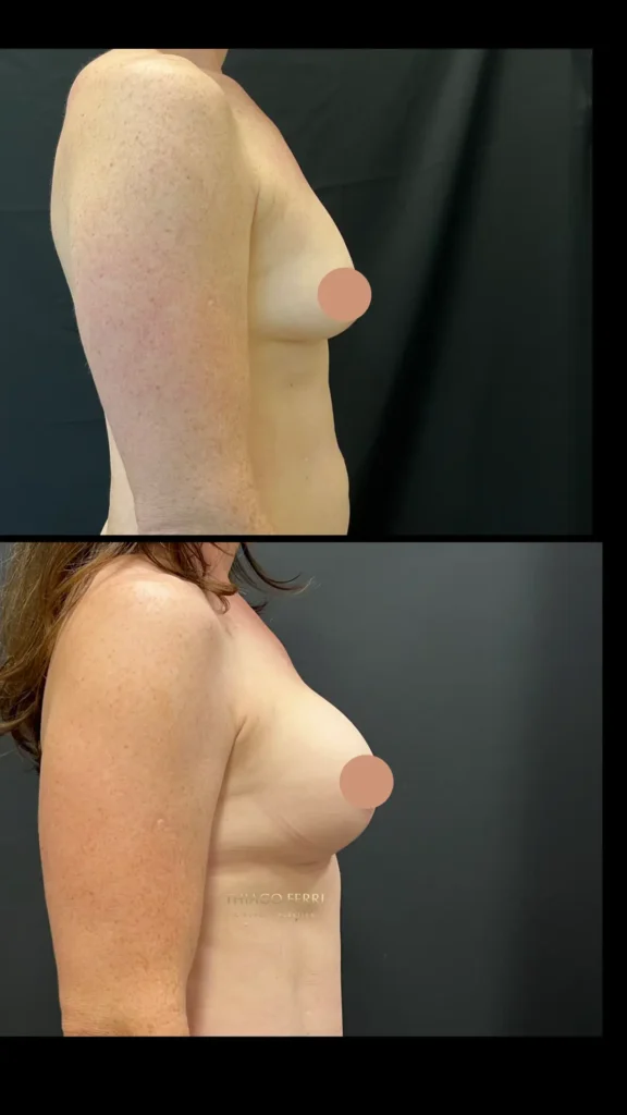 Antes e depois de mastopexia com próteses em Chapecó