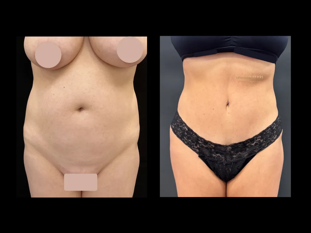 Antes e depois Chapecó