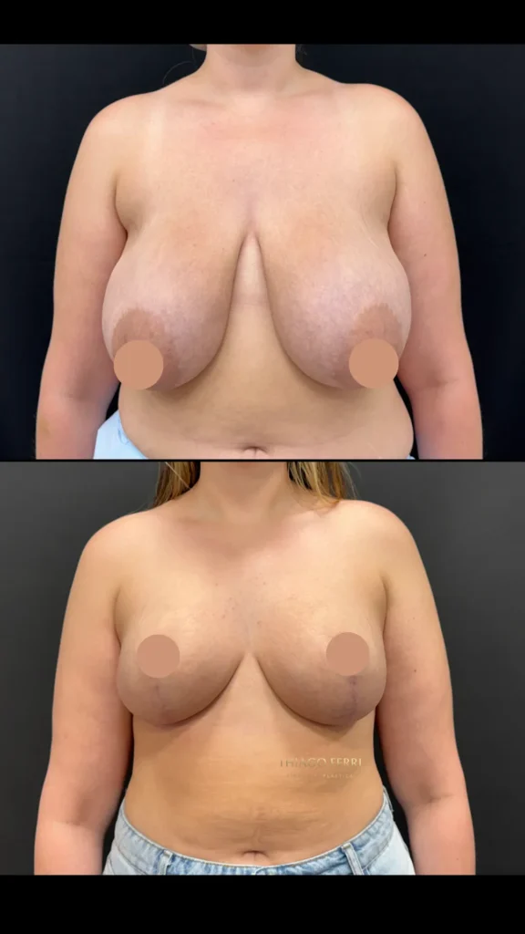 Antes e depois de mamoplastia redutora