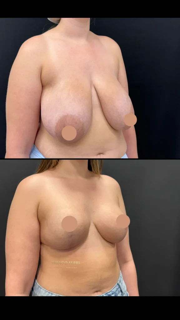 Antes e depois de cirurgia plástica em Chapecó