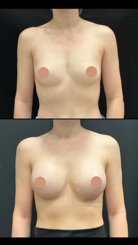 Caso A — antes e depois de mamoplastia de aumento, vista frontal