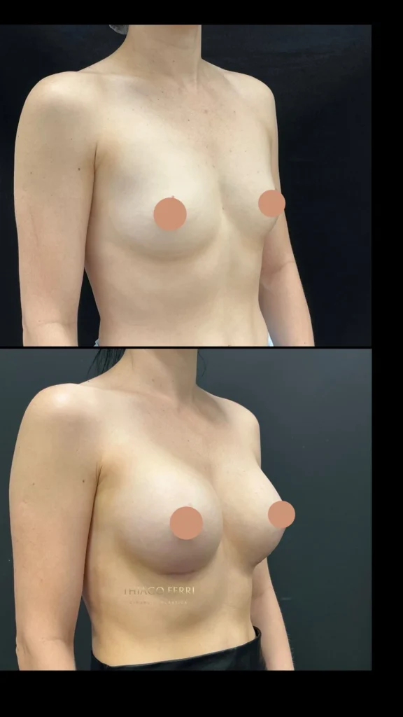 Caso A — antes e depois de mamoplastia de aumento, vista oblíqua