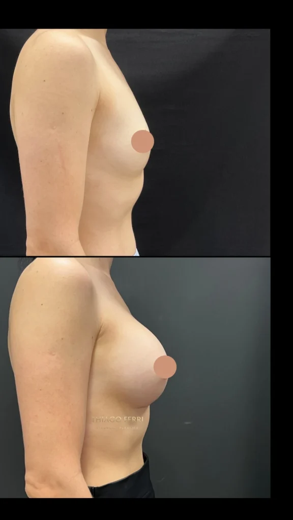 - Caso A — antes e depois de mamoplastia de aumento, vista lateral
