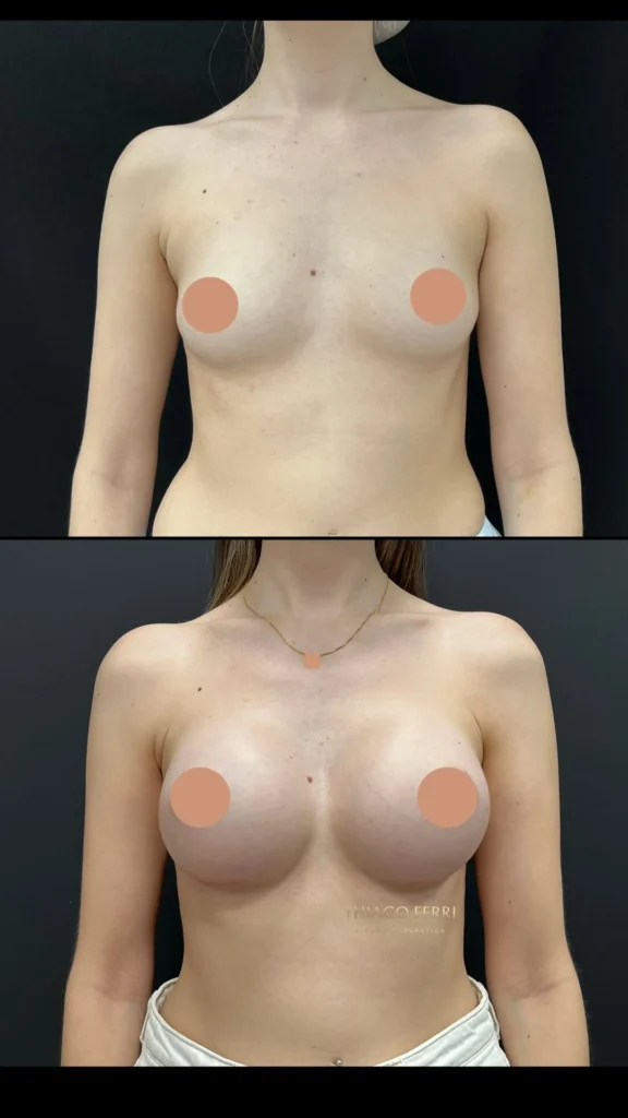 - Caso C — antes e depois de mamoplastia de aumento, vista frontal