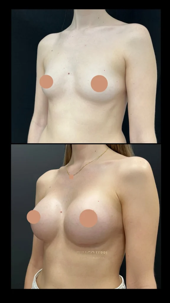 - Caso C — antes e depois de mamoplastia de aumento, vista oblíqua