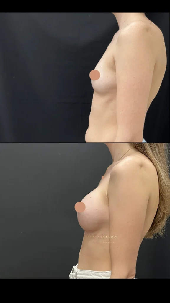 - Caso C — antes e depois de mamoplastia de aumento, vista lateral