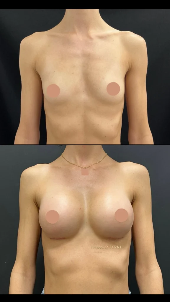 - Caso B — antes e depois de mamoplastia de aumento, vista frontal