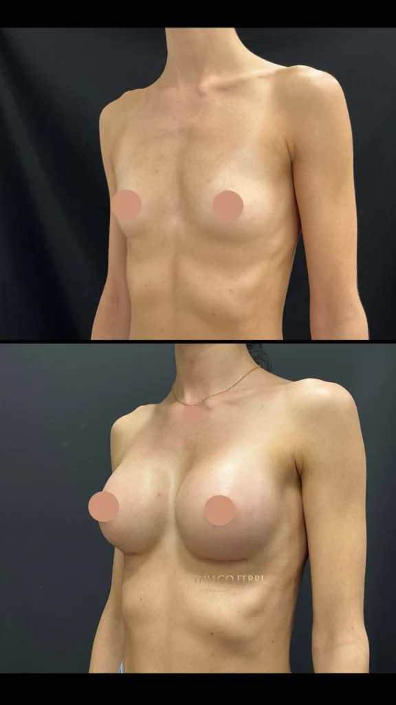- Caso B — antes e depois de mamoplastia de aumento, vista oblíqua