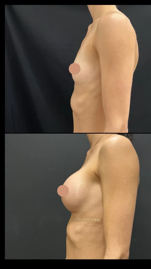 - Caso B — antes e depois de mamoplastia de aumento, vista lateral