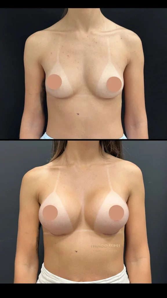 - Caso E — antes e depois de mamoplastia de aumento, vista frontal