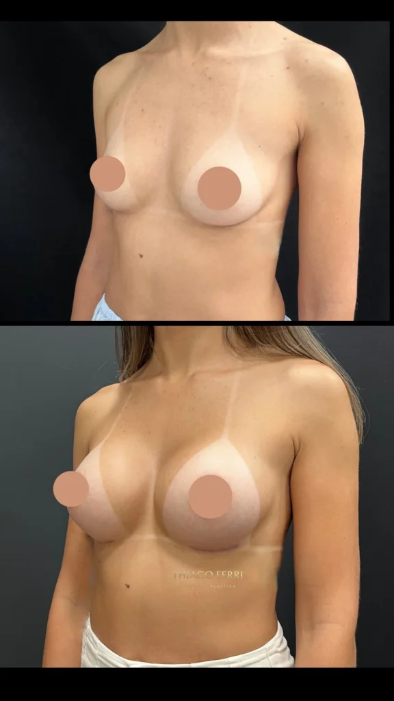 - Caso E — antes e depois de mamoplastia de aumento, vista oblíqua