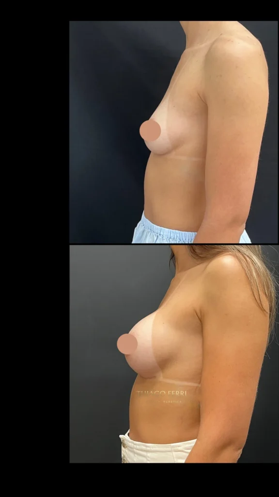 - Caso E — antes e depois de mamoplastia de aumento, vista lateral