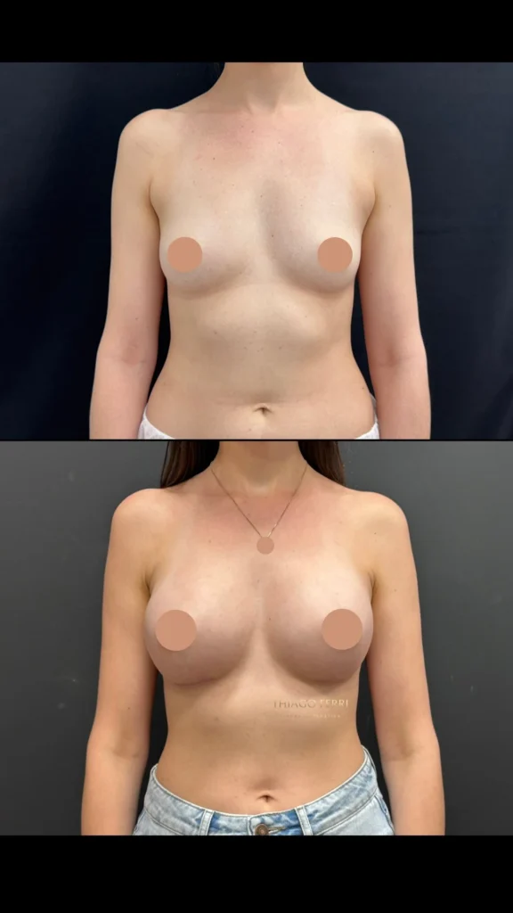 - Caso D — antes e depois de mamoplastia de aumento, vista frontal