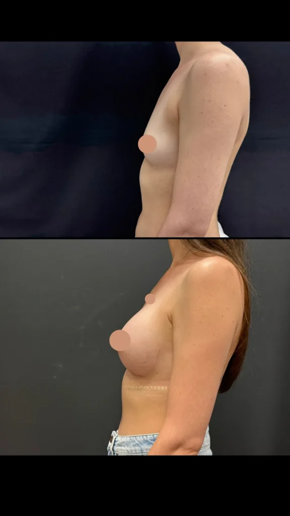 - Caso D — antes e depois de mamoplastia de aumento, vista lateral